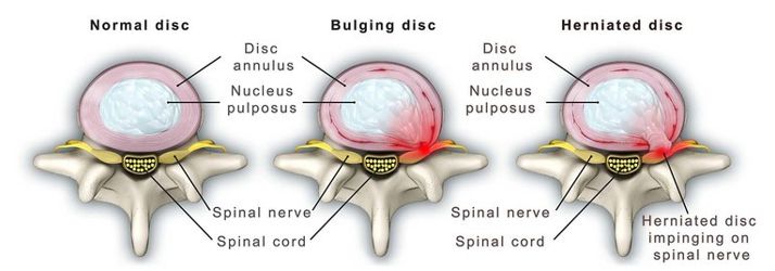 Image shows a normal disc, a bulging disc and a herniated disc